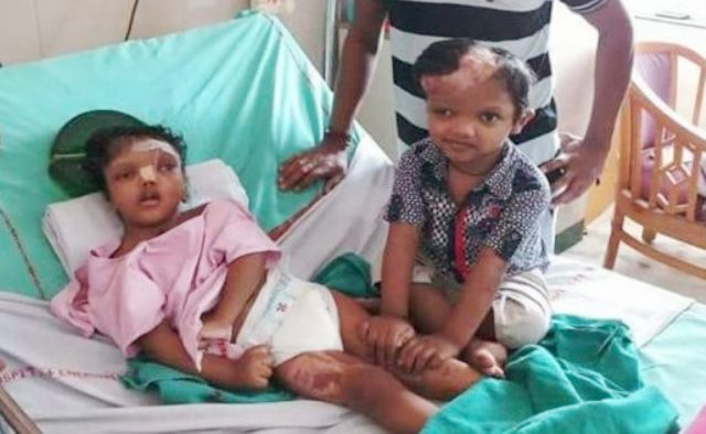 Kandhamal’s separated conjoined twin Kalia dies